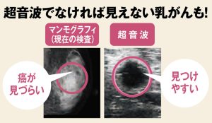 マンモグラフィと超音波検診　がんの見え方